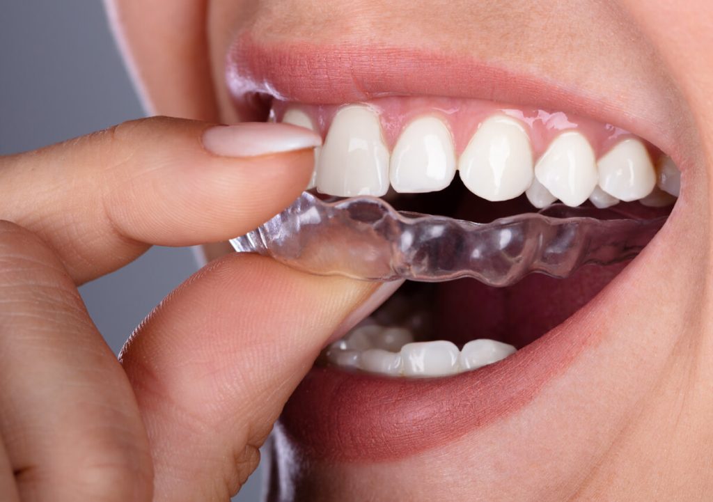 “Protecting Your Tongue The Benefits of a Mouthguard”
